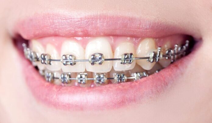 Pros and Cons of Traditional Braces
