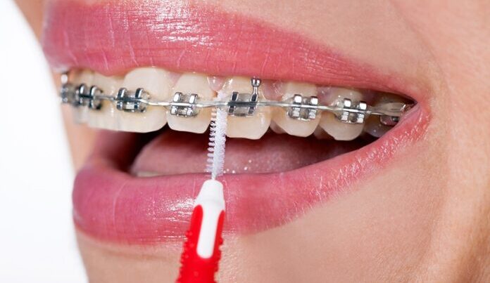 Traditional Braces Maintenance and care