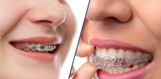 Traditional Braces or Invisible Aligners - What's Right for Your Smile