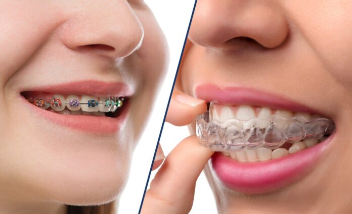 Traditional Braces or Invisible Aligners - What's Right for Your Smile