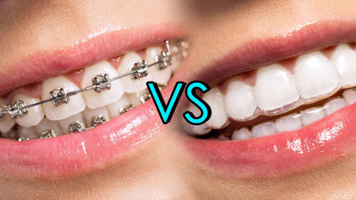 Traditional Braces vs Invisible Aligners