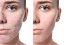 Acne Scar Correction