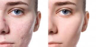 Acne Scar Correction