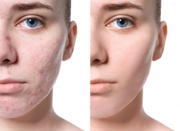 Acne Scar Correction