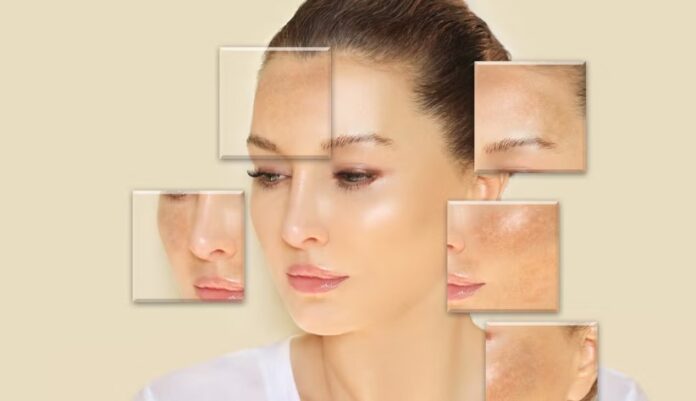 Causes of Melasma